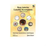 Deep Anterior Lamellar Keratoplasty Different Strokes 1st Edition by Vishal Jhanji